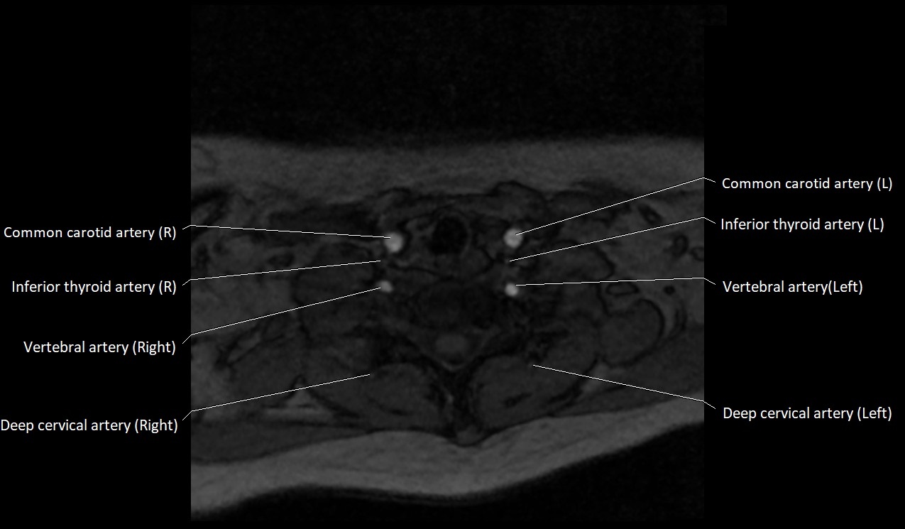 Carotid artery anatomy axial 3T image 60.jpg